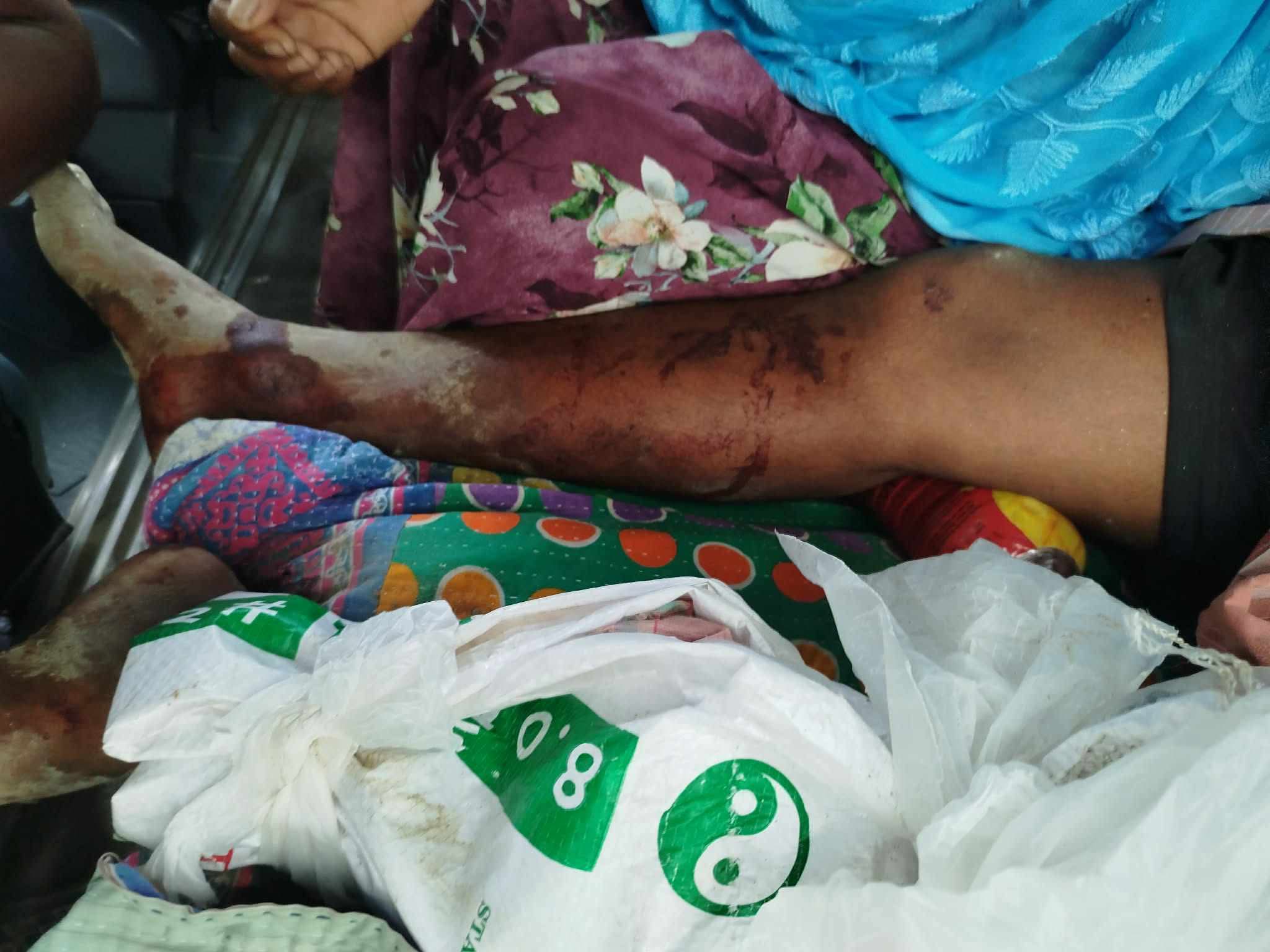 সিংড়ায় কৃষকের ওপর হামলা: মুমূর্ষু অবস্থায় হাসপাতালে চিকিৎসাধীন ভুক্তভোগী